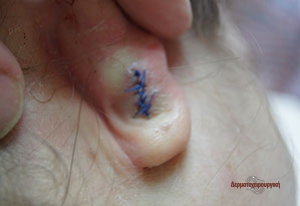 Cyst ear after