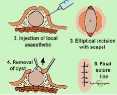 Sebaceous Cyst removal