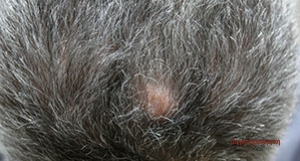 alopecia3