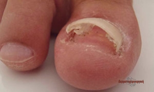 nail injury2