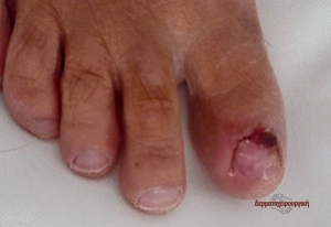 nail injury3