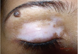 vitiligo before