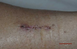 melanoma maria 6 days after