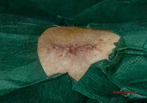 melanoma maria operation