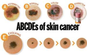 ABCDE Cancer