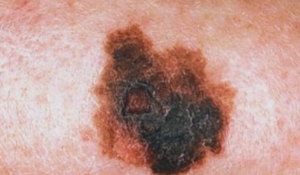 melanoma2